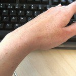 If You Suffer From Dermatitis, Your Water Quality Might Be To Blame